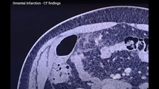 Omental infarction  CT findings [upl. by Glyn784]