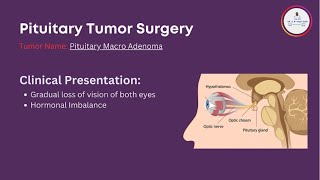 Endoscopic Pituitary Tumor Surgery [upl. by Malliw]