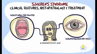 Sjogrens syndrome Part 2  Clinical features and Histopathology [upl. by Fitzsimmons669]