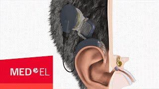 The MAESTRO Cochlear Implant System from MEDEL with OPUS2 XS  USA [upl. by Haelhsa]