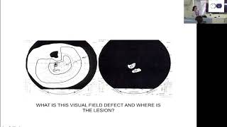 Visual Field Defects  Where is the Lesion Dr Henrietta Ho [upl. by Eiramlirpa]