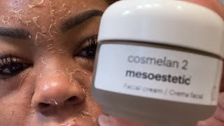 My unbelievable 30 day Cosmelan Peel journey [upl. by Ira240]