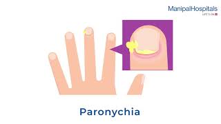 What is Paronychia and Its Treatment  Manipal Hospitals India [upl. by Reivaz]