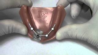 Implant Bar Overdenture  Model Demonstration [upl. by Deanne]