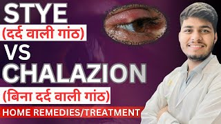 Stye vs chalazion  Difference between stye and chalazion [upl. by Seyler364]