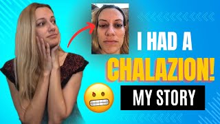 CHALAZION Symptoms Treatment Risk Factors Recovery My Story [upl. by Norab]