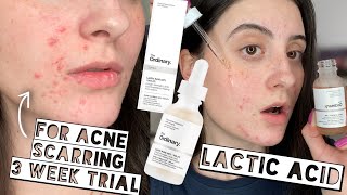 TESTING THE ORDINARY LACTIC ACID 10  HA ON ACNE SCARS FOR 3 WEEKS  Sensitive  Dry Skin [upl. by Tlaw]