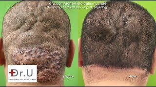 How to Get Rid of Bumps on Head  AKN Surgical Removal [upl. by Anahs]