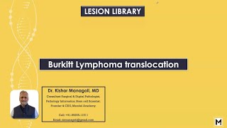 Pathology of Burkitt Lymphoma Translocation [upl. by Kylander]