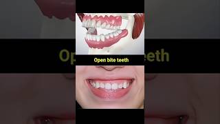 Open Bite teeth teeth braces dentist dentisty cosmeticdentistry orthodontist shorts short [upl. by Llorrac]