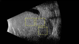 Spontaneous Vascular Pulsations Within Intraocular Mass [upl. by Aimehs]