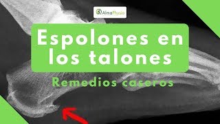 espolones en los talones remedios caseros [upl. by Kev]