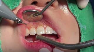 Surgery video K2 LASER by Dentium for Simple Gingivectomy on Anterior Maxilla [upl. by Nilat666]