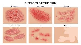 SAKIT sa BALAT Pimples Rushes Eczema Pigsa  ni Doc Katty Go Dermatologist 21b [upl. by Leban799]