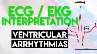 Ventricular Arrhythmias  ECG EKG Interpretation Part 5 [upl. by Magas306]