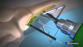 Distal Femoral Osteotomy Animation [upl. by Legnaleugim]