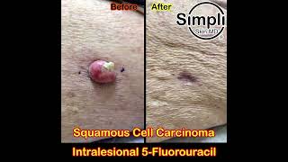 Squamous Cell Carcinoma Intralesional 5Fluorouracil [upl. by Reham]