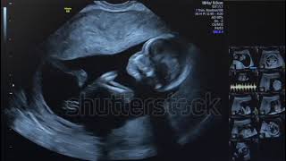 Fetal ultrasound Foetus movement [upl. by Aurie]