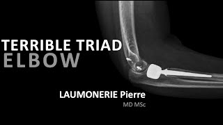 Terrible triad injury of the elbow  Terrible triade du coude  par le Dr Laumonerie [upl. by Repsihw961]