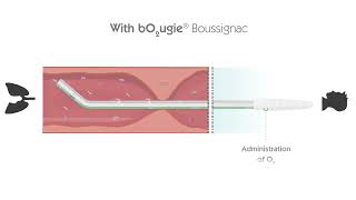 Bougie Boussignac for difficult intubation  Vygon [upl. by Fachini]