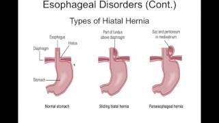 Chapter 36 Gastrointestinal Disorders BIOL300 [upl. by Oyek]