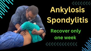 Ankylosis Spondylitis Recover Only One Week ankylosing spondylitis symptoms treating ankylosing [upl. by Leay]