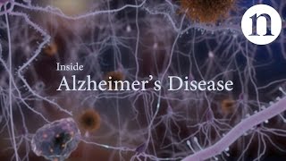 Inside Alzheimer’s disease [upl. by Krista]