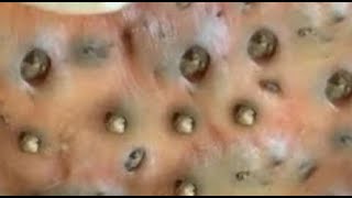 20 Biggest blackheads removed by pinching and squeezing by an expert [upl. by Dnalrag]