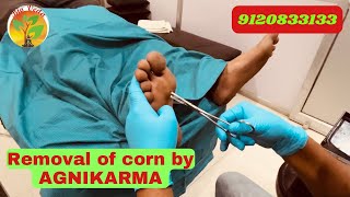 Painful Corn removal by AGNIKARMA agnikarma drsanjeevsingh ayodhya viral panchkarma [upl. by Lehte]