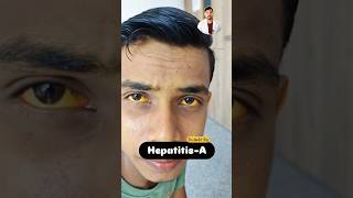 Hepatitis  Jaundice patient 😔  DrAnkit  health doctor shorts [upl. by Eednac320]