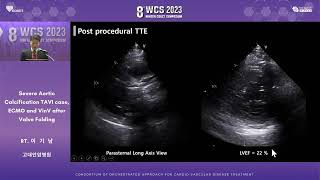 AUDITORIUM 2023 WCS 64  Severe Aortic Calcification TAVI Case 이기남 [upl. by Doss]