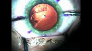 Clear lens extraction with Alcon Acrysof IQ Restor Toric DrMishevavi [upl. by Thurston]