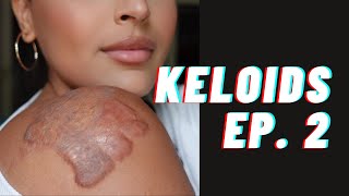 My Keloid Journey  Ep 2  Treatments amp Scar Camouflage at The Basma Hameed Clinic Toronto [upl. by Eveivenej]