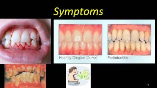 ANUG  severe gingivitis [upl. by Vitia330]