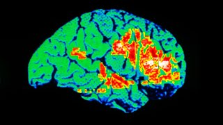 Un Chico Frotó 1 Tubo De Crema Para Alivio del Dolor Entre Sus Piernas Esto Le Sucedió A Su Cerebro [upl. by Hungarian]