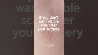 Heal your incision areas the right way plasticsurgerykorea scartreatment koreanbeauty [upl. by Alvira]