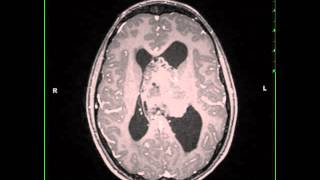 Atypical Neurocytoma [upl. by Liek]