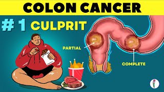 1 🔥 Cause of Colon Cancer amp how to prevent it  Colon Cancer  causes  Rectal cancer [upl. by Melleta]