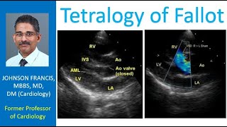 Tetralogy of Fallot [upl. by Patton]