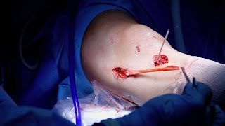 MCL Reconstruction Surgery [upl. by Marchal]