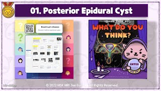 MindMap 01 Epidural cysts Baastrups Disease Retrodural space interspinous bursitis [upl. by Secunda383]