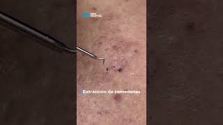 Extracción de comedones puntos negros  Skin Hospital  puntosnegros [upl. by Tali]