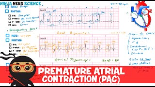 Rate and Rhythm  Premature Atrial Contraction PAC [upl. by Elyse]