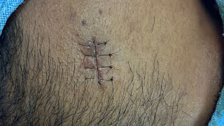 Vertical mattress suture skin closure technique suture technique [upl. by Kcirted]