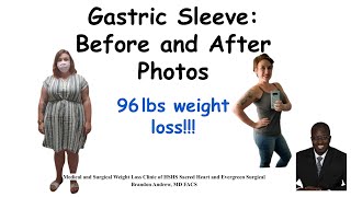 Gastric Sleeve Before and After Pictures and Results  Bariatric Weight Loss Surgery Journey Results [upl. by Asilav]