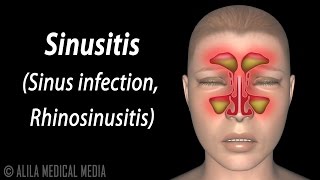 Sinusitis Animation [upl. by Hawken]