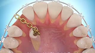 Impacted Cuspid Palatal Treated [upl. by Winonah]