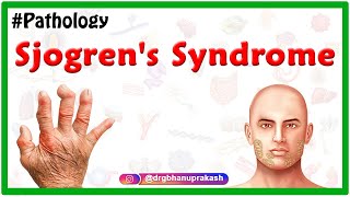 Sjogrens syndrome Usmle  Etiology  Clinical features  Diagnosis  Treatment [upl. by Orferd]