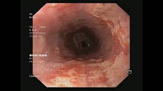 Pill induced esophagitis  Dr Nikhilesh Yandamuri [upl. by Orazio]