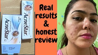 Acnestar Gel amp Acnestar soap Review amp results HOW TO GET RID OF ACNE FAST Pimples blackheads [upl. by Hewart]